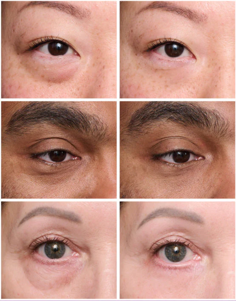 LumiLift Instant Tightener