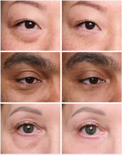 LumiLift Instant Tightener